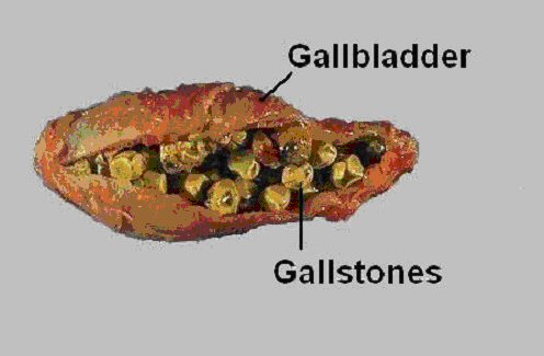 What Causes Gallstones in Gallbladder
